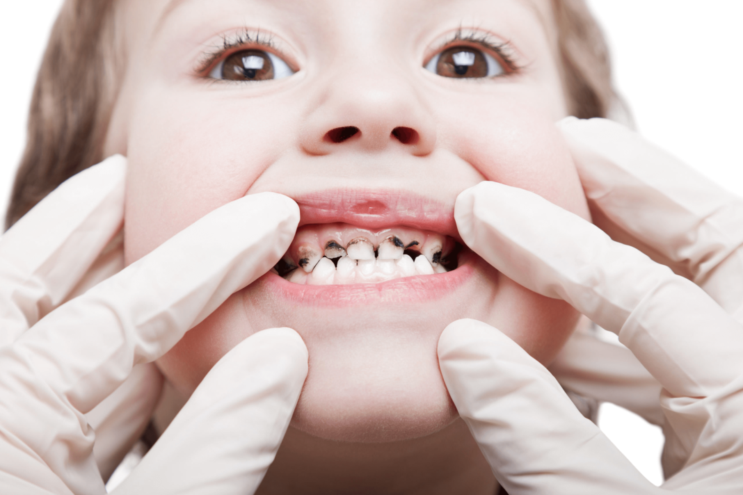 Should You Treat Baby Tooth Cavities